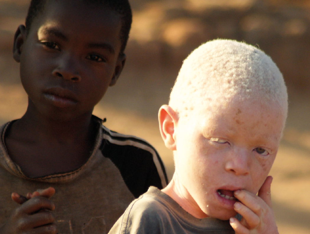 La persecuzione degli albini in Malawi